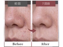 フルリール/【毛穴デトックス】