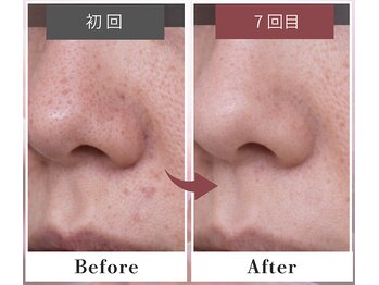 フルリール/【毛穴デトックス】