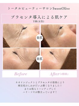 スウィートオリーブ 春日部(SweetOlive)/スーパー美容液プラセンタ