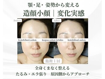 イチカ 仙川店( ichika)の写真/【筋膜から引き上げる】
口元・ほうれい線のたるみを引き上げる◎姿勢から整える本格たるみ改善小顔矯正