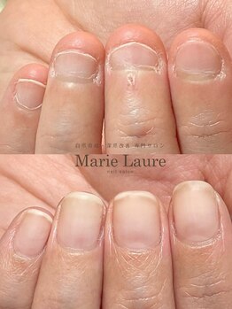 マリーロール 梅田店(Marie Laure)/自爪育成/深爪矯正/ネイルケア