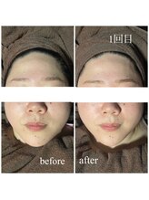 ラクラク(rakuraku)/リフトアップフェイシャル【女】