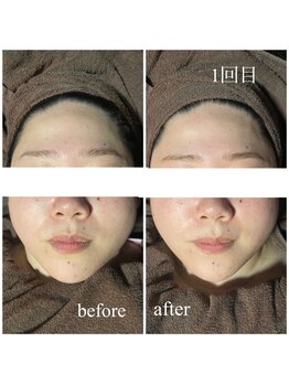 ラクラク(rakuraku)/リフトアップフェイシャル【女】