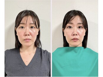 エピファニー 東京 銀座/ビフォーアフター(S様 30代)