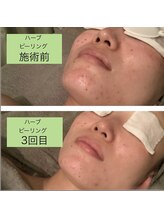 ゲッカ(GEKKA)/ハーブピーリング