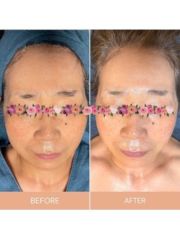 ベル(Belle)/小顔リフトアップフェイシャル