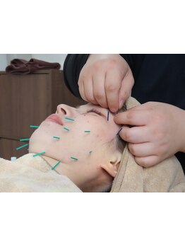 鍼灸施術を受けたい