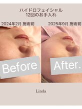 リンダ 西宮店(LINDA)/ハイドロフェイシャル