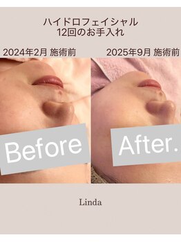 リンダ 西宮店(LINDA)/ハイドロフェイシャル