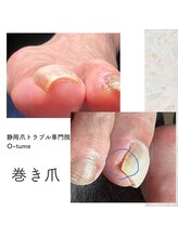 オツメ 静岡(O-tume)/巻き爪