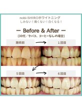ノビシロホワイトニング(nobi-SHIROホワイトニング)/美容セルフホワイトニング
