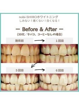ノビシロホワイトニング(nobi-SHIROホワイトニング)/美容セルフホワイトニング