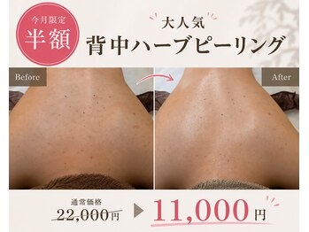 エレナ(Elena)の写真/9月限定！半額！大人気のお背中ハーブピーリング/背中ニキビケア/背中跡ケアにオススメです！