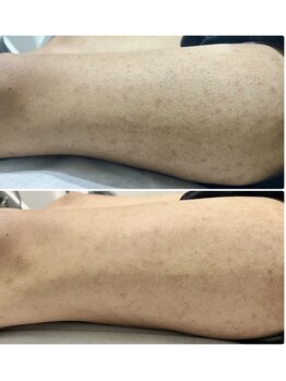 OBS/清潔感/メンズボデイ脱毛