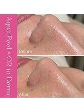 ハナイロ(hana-iro)/アクアピール×白玉酸素セラピー