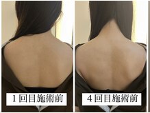 リモド(Rimodo509)/肩甲骨はがし（リンパマッサージ