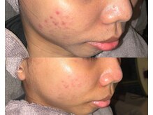 ル シーニュ/毛穴エクストラクション