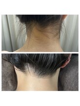 白美/うなじ脱毛／背中脱毛