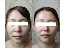 チャング ユー(CHANG YOU)の雰囲気（骨気ビフォー→アフター「たるみ緩和・立体感・引き締り」）