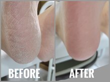 冬になる前、たった１回で実感！つるふわ赤ちゃんかかとに♪