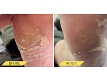 ふっとけ庵/タコ・魚の目ケア