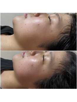 ルピナス 立川店/小顔矯正