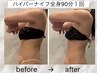 新規限定【全身痩身ハイパーナイフ】90分脂肪燃焼×むくみ解消¥15,400→