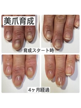 マニュコクーン(ManuCocoon)/爪育成 深爪 巻き爪 大阪市