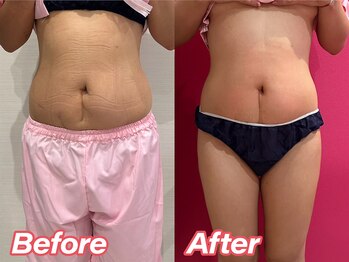 ソイズ 新保店(SOIS)/■脂肪冷却&電磁パルス 変化写真