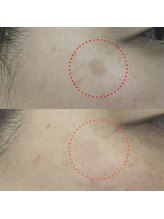 ラヴィアンローズ(La vie en Rose)/シミケアコース