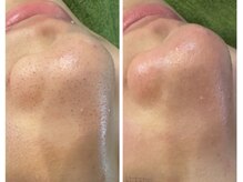 メディカル サンテロッソ(MEDICAL SANTEROSSO)の雰囲気（1回で驚きのキレイさ！感動レベルの毛穴ケア）