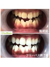 ルブラン 奈良店(Le Blanc)/めちゃくちゃ白くなりました！