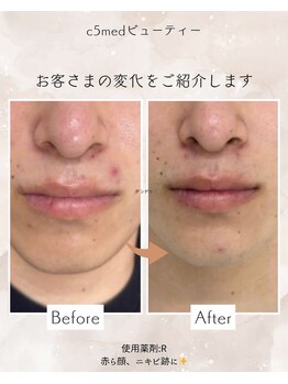 シーファイブメットビューティ 西11丁目店(C5medビューティ)/ビフォーアフター