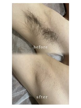 メルシー13/ワキ脱毛