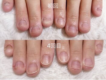 グラシナ なんば店/深爪/自爪育成/フィルイン