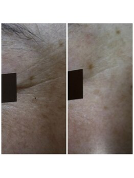 ダリア(DALIA)/エンダモリフトでコラーゲン生成