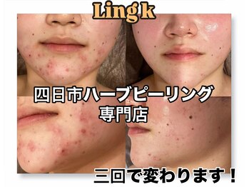 リングケー(Ling K)/ハーブピーリングエステ