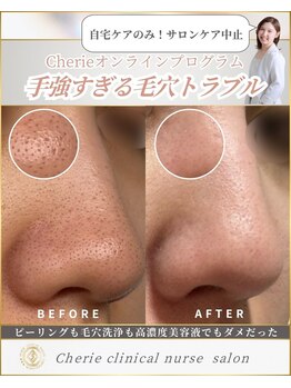 シェリー(Cherie)/施術なし！長年悩む毛穴ケア
