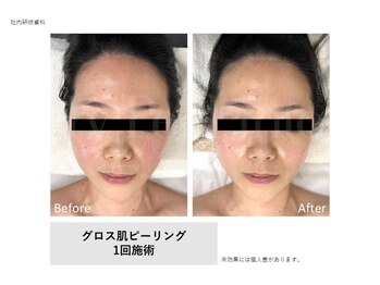 リュクシア(LUXIA)の写真/ファンデで隠しきれない【黒ずみ・開きに】ハイドラ×水素ピーリングで、つるんと滑らか透明感ある素肌へ◎
