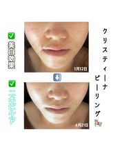 アイリス(AIRIS)/毛穴洗浄/ニキビケア/シミケア