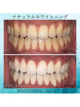 ホワイトニングビューティー つくば店/最速ホワイトニング