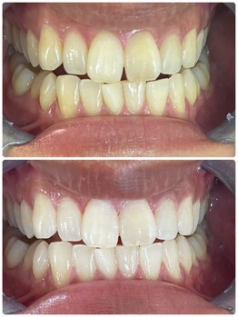 エクシアホワイトニング 新小岩店/ホワイトニングビフォーアフター