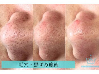 リメイククリニカルビューティー(Remake clinical beauty)/毛穴の黒ずみ、ざらつき改善