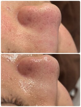 リラベル(Lira Belle)/毛穴の汚れを吸引