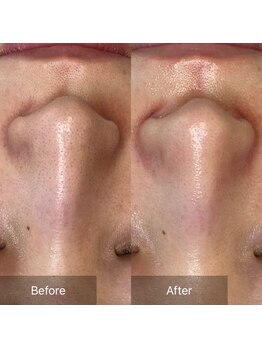 フローレ 平針店(Flore)/気になる小鼻も黒ずみも