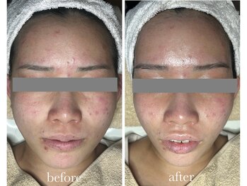 サロン ド ラム/【リフトアップ】2回目の効果