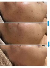 ファルファラ(farfara)/天然ハーブピーリング