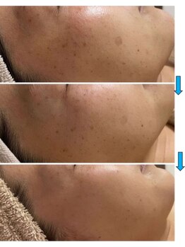 ファルファラ(farfara)/天然ハーブピーリング