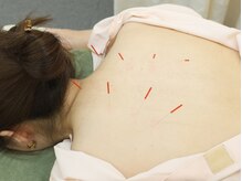 丸太町骨盤整骨院 鍼灸院/肩こり・腰痛に鍼灸のちから