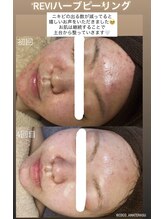 ココ(COCO)/ハーブピーリング4回目